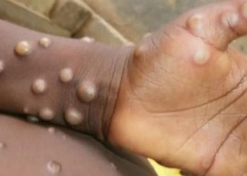 تدابير صحية بشأن جدري القرود